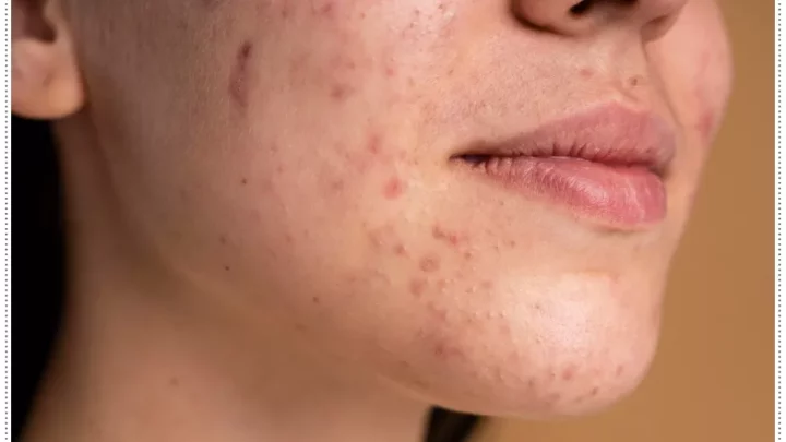 As principais diferenças entre a foliculite e a acne: saiba como identificar cada uma