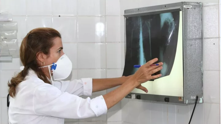 Governo cria comitê para reduzir casos de tuberculose até 2030